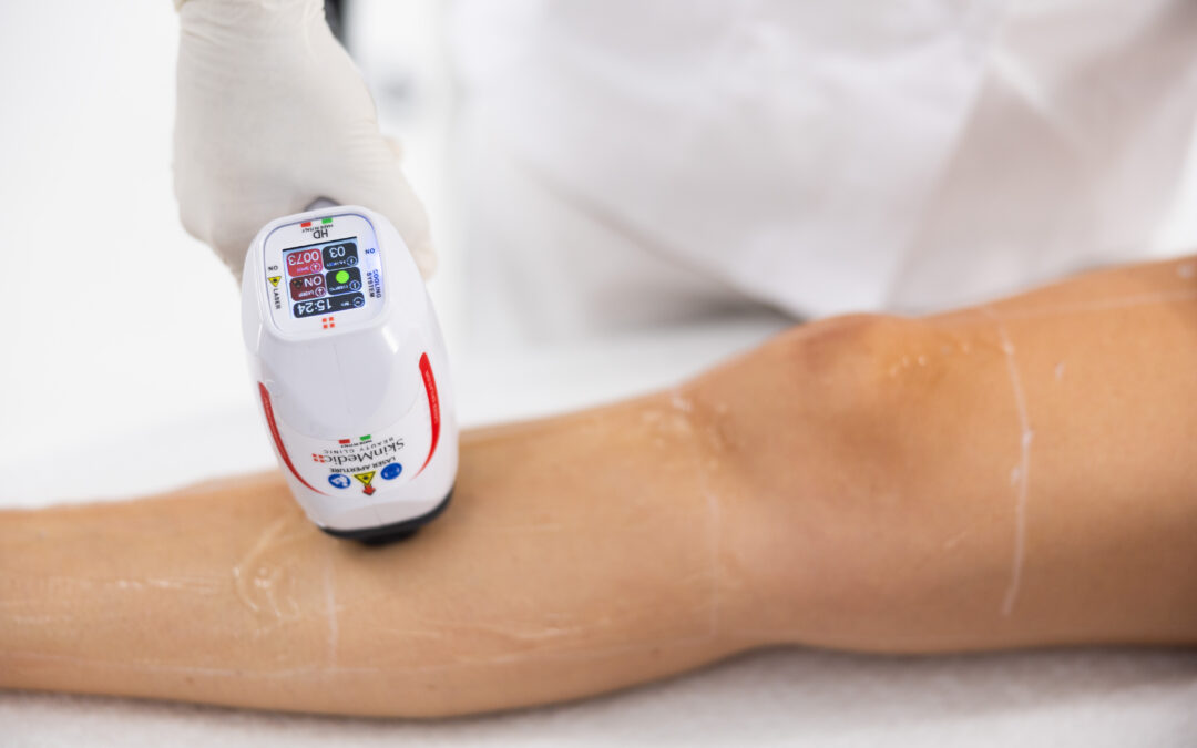 Stopo alla Follicolite: con l’epilazione laser pelle liscia sempre