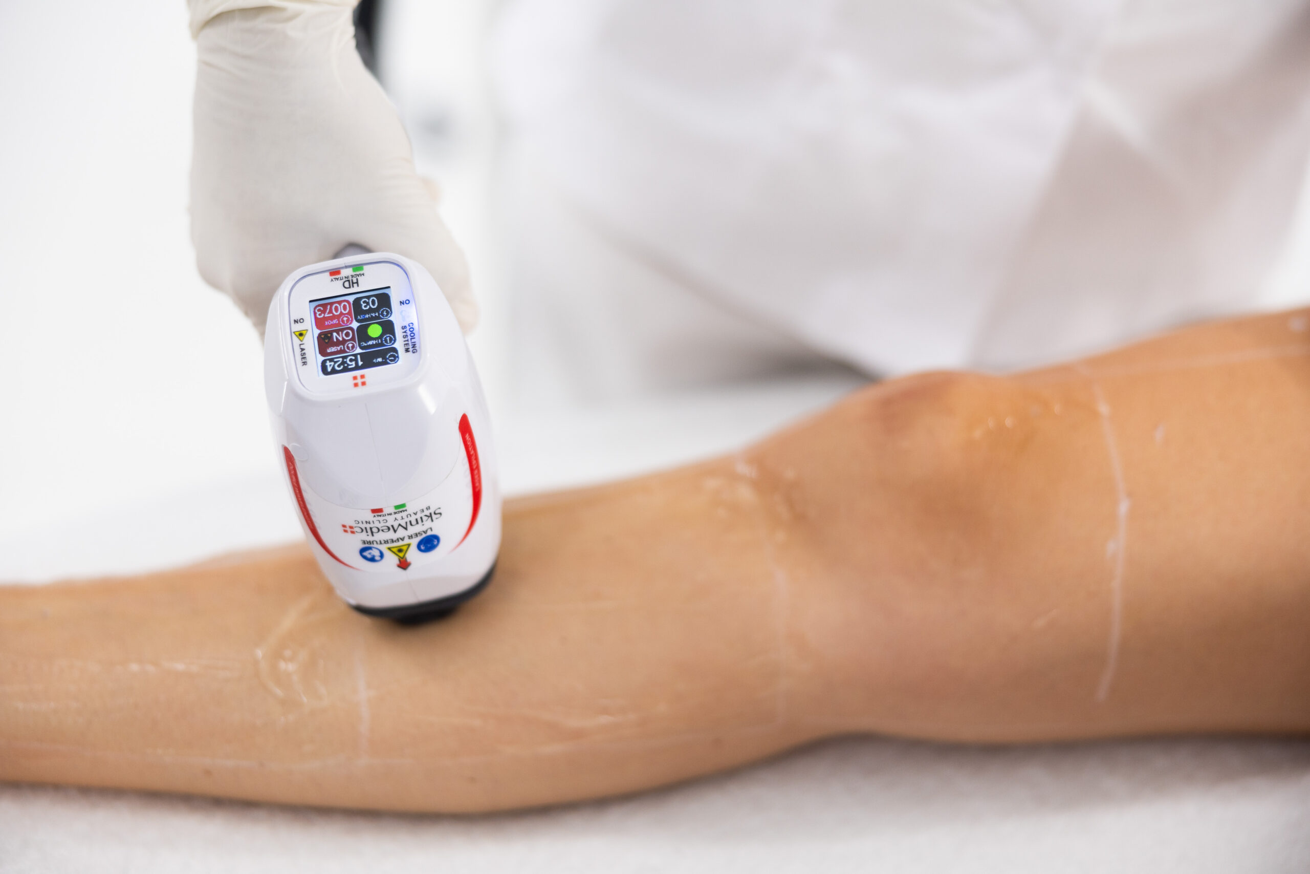 epilazione laser a diodo corpo novara